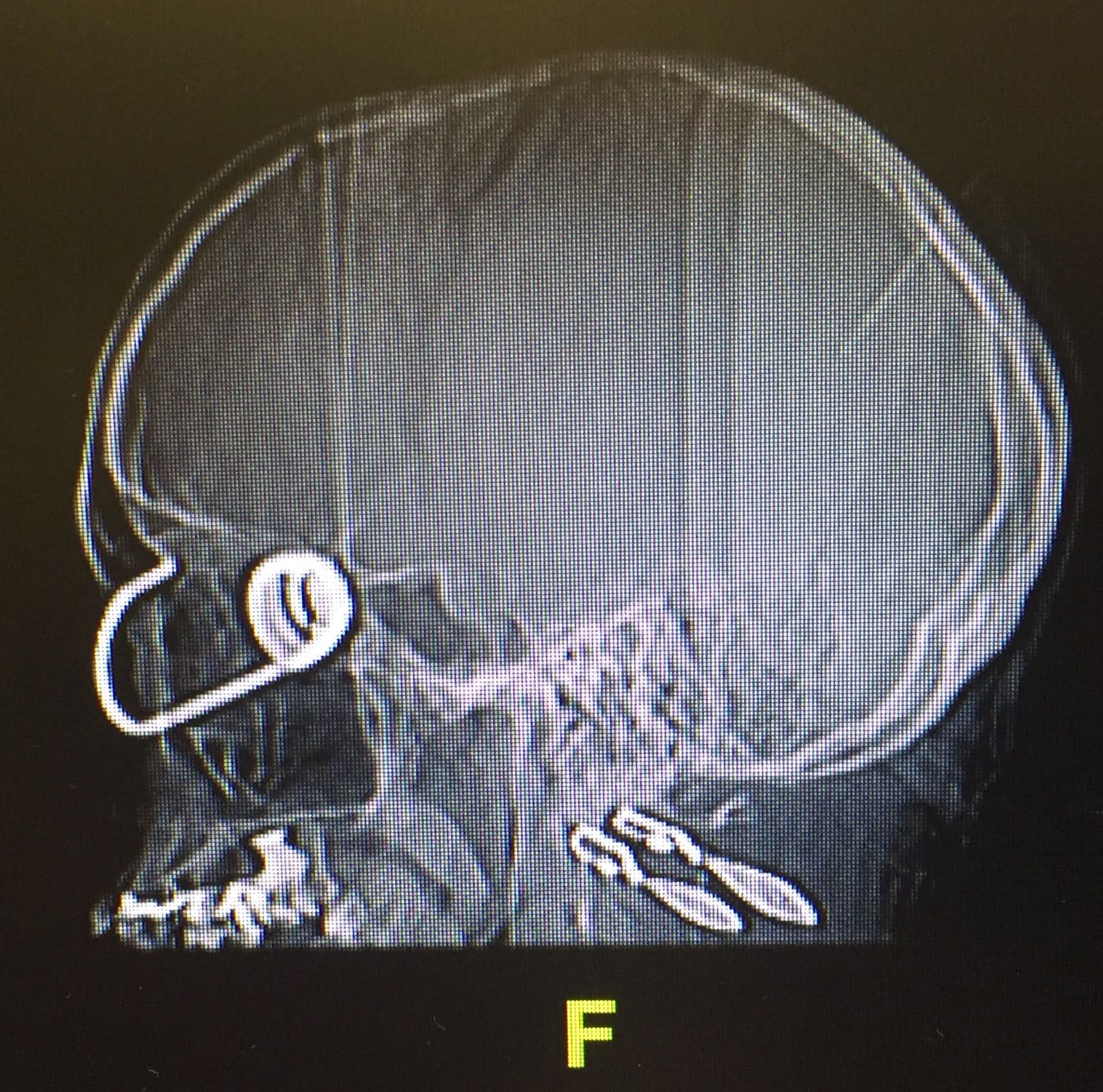 X-ray of Kazunina's head after she got a cord from her suitcase stuck in her eye (credit: Ichilov Spokesperson's Office)