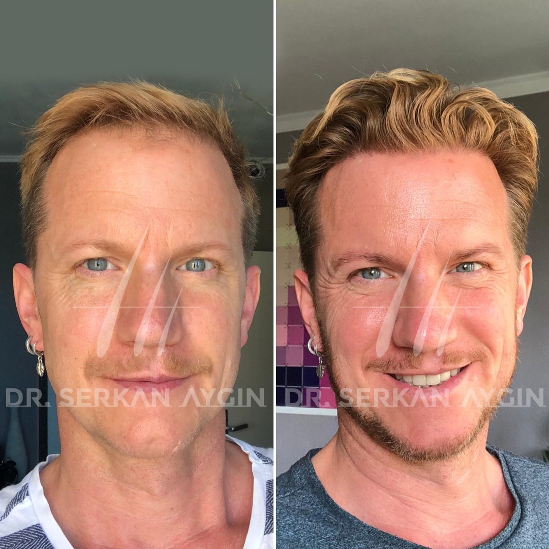 Natural and dense looking before and after results (Credit: Dr. Serkan Aygin Clinic)