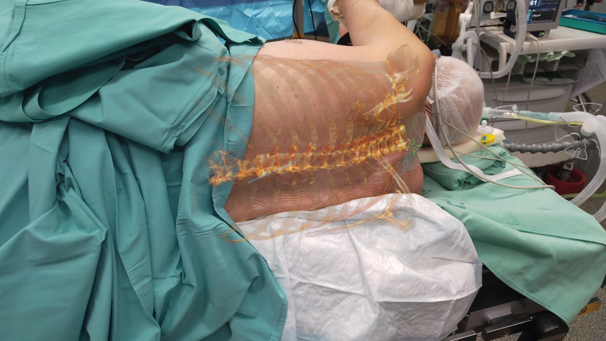A virtual image of the spine and ribs from the patient’s superimposed CT scan, shown while the team prepares for surgery. This is for the purpose of an epidural injection (Credit: Novarad)