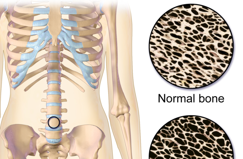 Osteoporosis Locations. Animation in the reference. Image provided by Blausen Medical Center (photo credit: Wikimedia Commons)