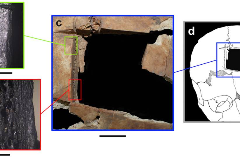 Remains at archaeological site from Bronze Age Israel had brain surgery ...