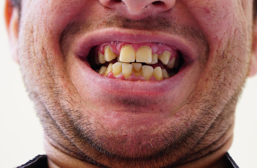  A smile with crooked teeth (photo credit: PIXABAY)