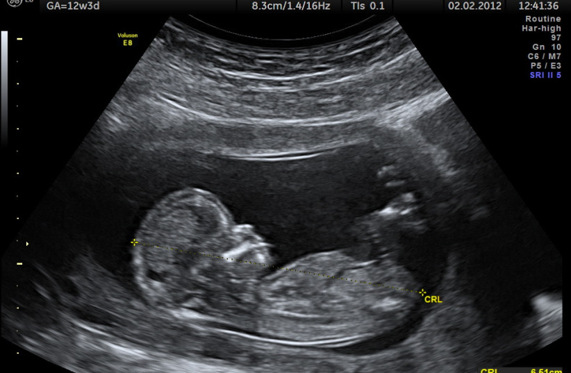  Illustrative image of a fetus. (photo credit: Wikimedia Commons)