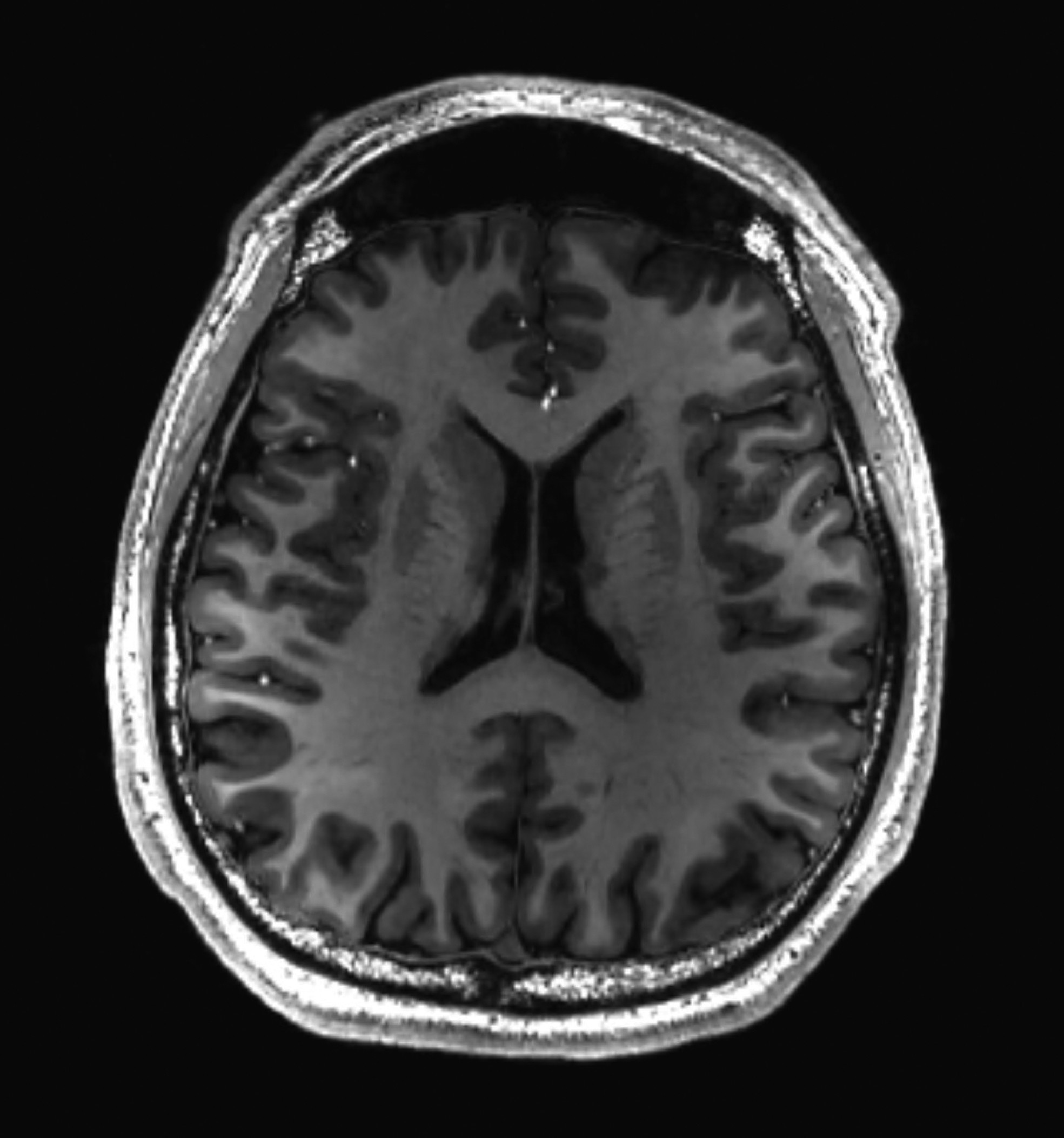  CROSS-SECTIONAL T1-weighted MRI of a healthy human brain. (credit: WikimediaCommons/Asnaebsa)