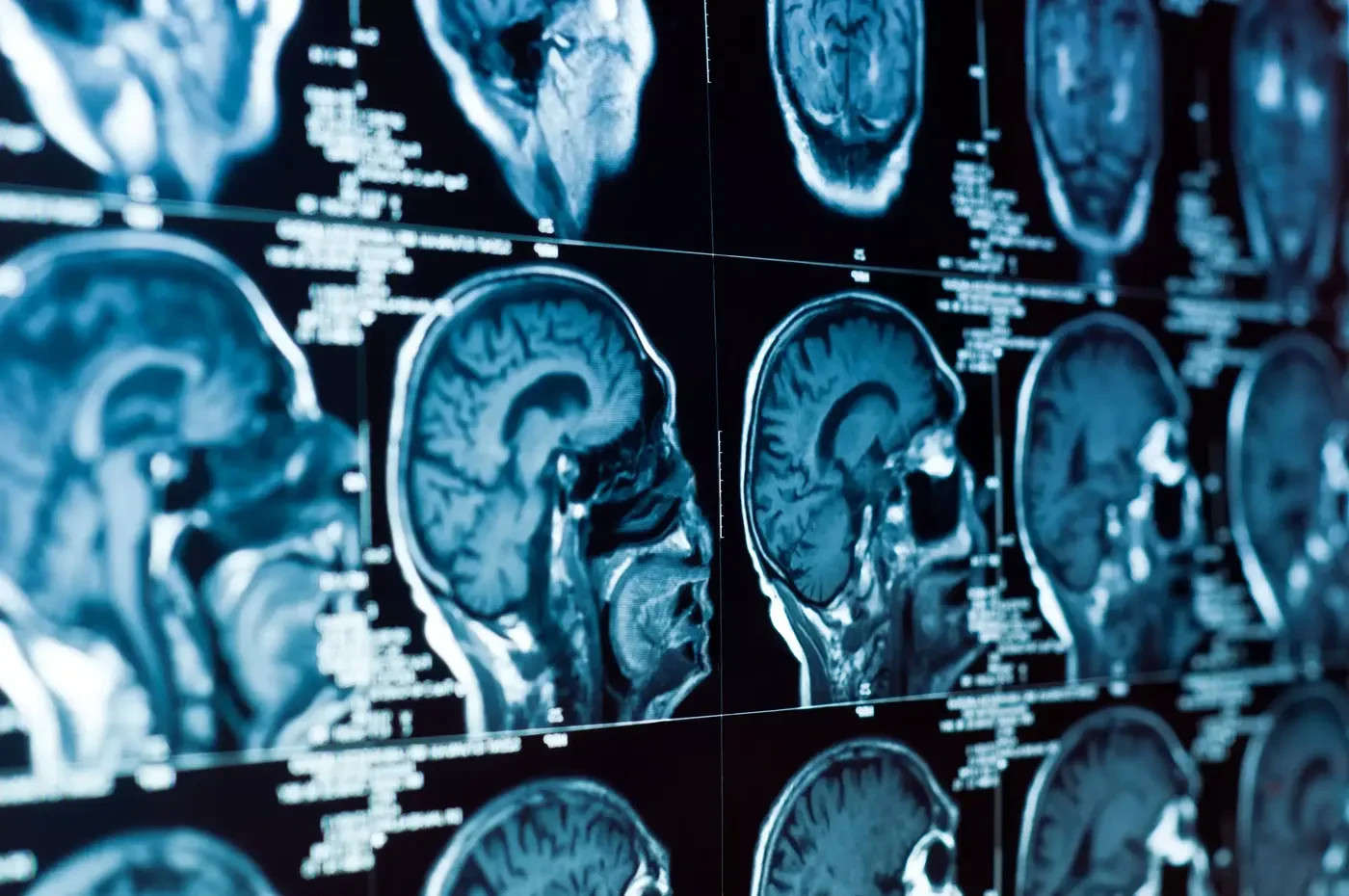 CT scan