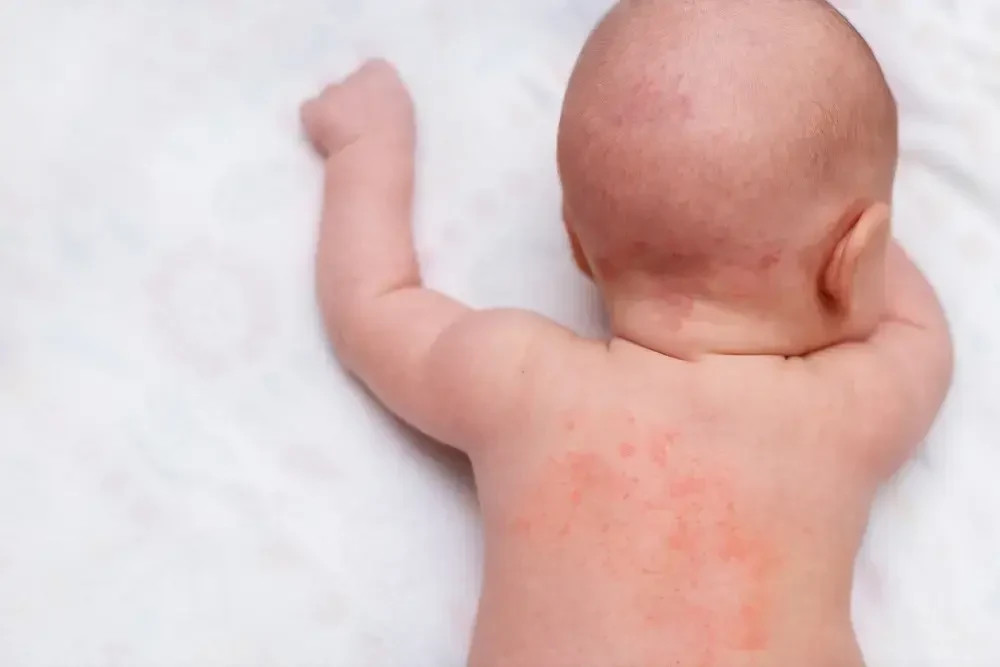 Baby with a rash