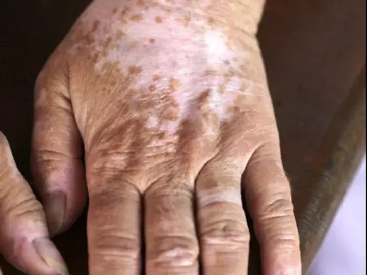 For many years we focused mainly on the spots on the skin. Today it is clear that the coping of many patients does not end with external appearance