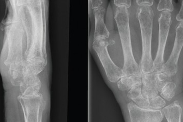 Bones X-ray hand skeleton 390 (credit: Wikimedia Commons)
