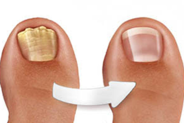 Toe nail rejuvenation (credit: CARE G.B. PLUS LTD)