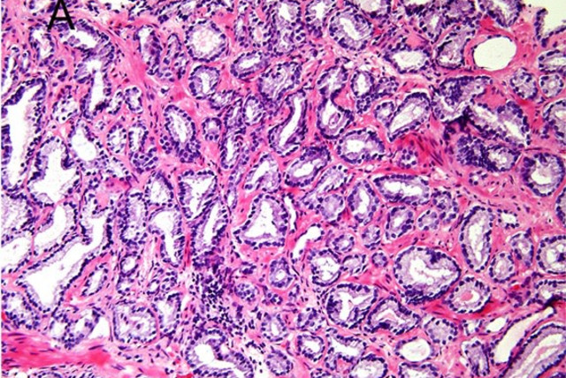  Micrograph of prostate cancer with Gleason score 6 (3+3) (credit: Diagnostic Pathology 11/Jennifer Gordetsky and Jonathan Epstein)