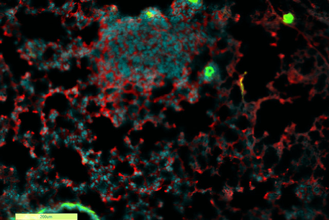  An image of lung with breast cancer metastasis, surrounded by inflammatory complement protein: Cyan: Cell nuclei; Red: Complement protein; Green: blood vessels; (credit: LEA MONTERAN)