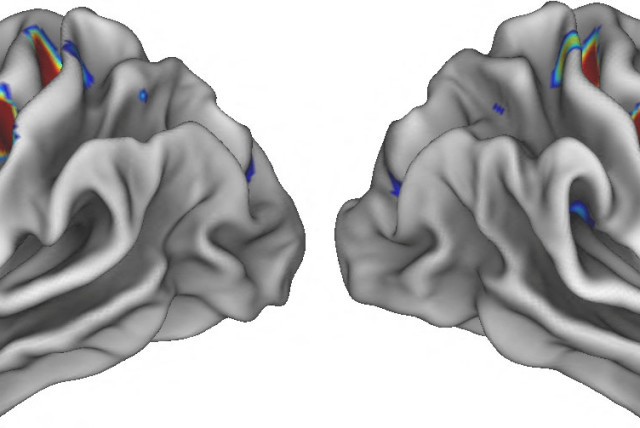  Three coloured spots on each half of the brain illuminate special locations in the movement areas of the brain that connect to areas involved in thinking, planning and control of basic bodily functions such as heart rate, in an undated illustration. The hotter the colour, the stronger the connectio (credit: Evan Gordon/Washington University/Handout via REUTERS)
