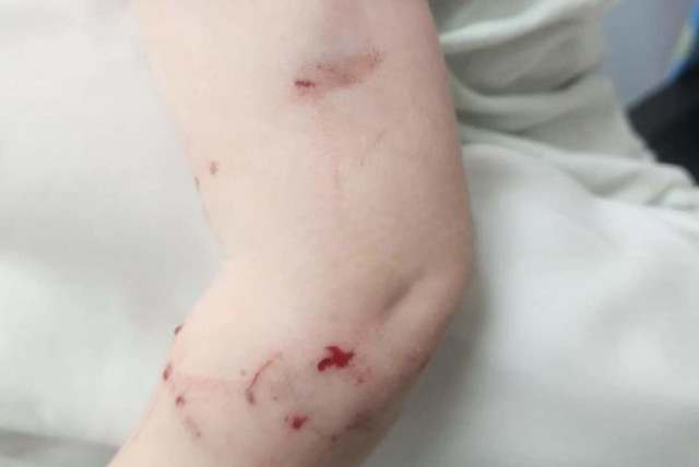  Rat bites on a girl in Bnei Brak. (credit: Tana Media)