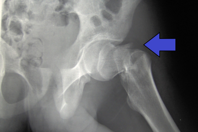  An X-ray image of a hip fracture. (photo credit: Wikimedia Commons)