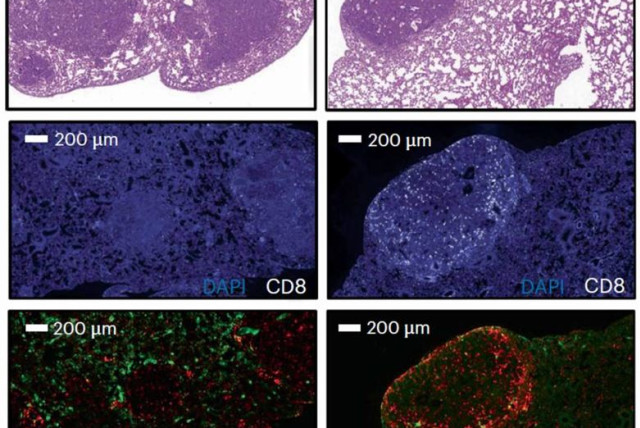 Tissues from mice transplanted with lung cancer cells. When PSME4 levels are high (left, top and bottom), the tumors grow bigger, cancer-fighting killer T cells (white) are reduced (top) and regulatory T cells (green) that inhibit the immune response are more abundant (bottom), compared with regular (photo credit: WEIZMANN INSTITUTE OF SCIENCE)