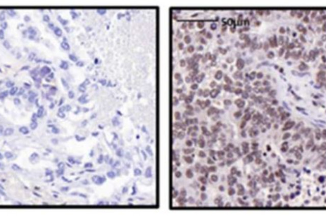 Tissue samples removed from a patient with non-small cell lung carcinoma reveal much lower levels of the PSME4 protein (brown) in the noncancerous tissue adjacent to the tumor (left) than inside the tumor itself (right) (credit: WEIZMANN INSTITUTE OF SCIENCE)