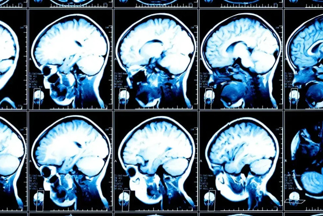 Brain scans (credit: SHUTTERSTOCK)