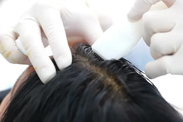  Injection of synthetic hair in the scalp (credit: Hairstatics)