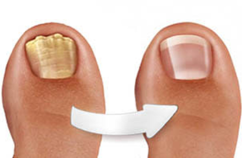 Toe nail rejuvenation (credit: CARE G.B. PLUS LTD)