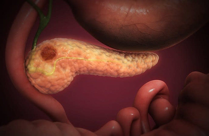 Cancerous cells forming a lump in the pancreatic tissue (credit: WIKIMEDIA COMMONS/SCIENTIFIC ANIMATIONS INC.)