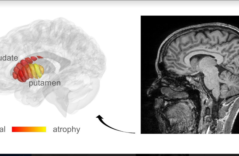  MRI images used for automatic detection of microstructural changes in early-stage Parkinson’s Disease (PD) patients. Marked in yellow are areas in the putamen where PD patients show tissue damage, compared to healthy controls. (credit: MEZER LAB/HEBREW UNIVERSITY)