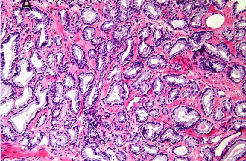  Micrograph of prostate cancer with Gleason score 6 (3+3) (credit: Diagnostic Pathology 11/Jennifer Gordetsky and Jonathan Epstein)