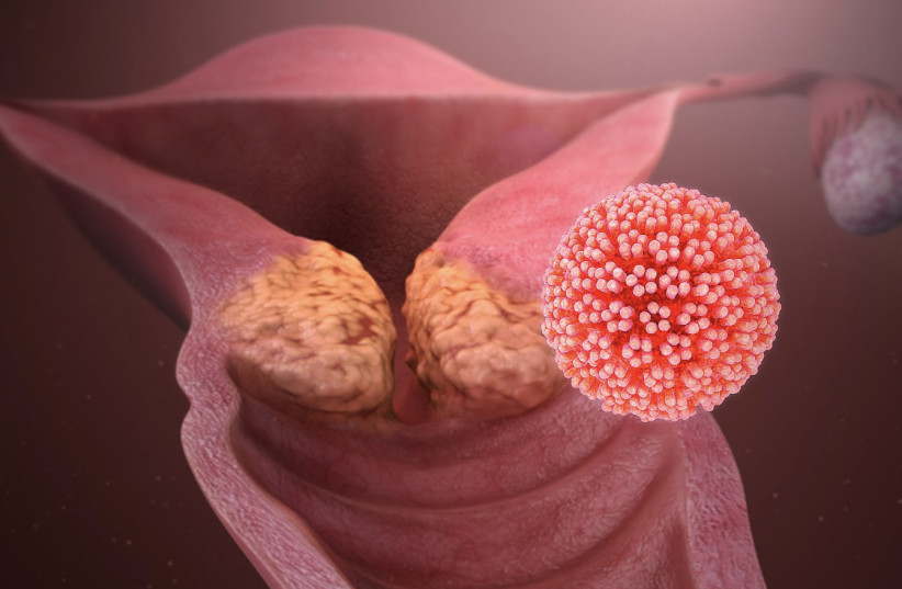  HPV causing cervical cancer (photo credit: WIKIMEDIA)