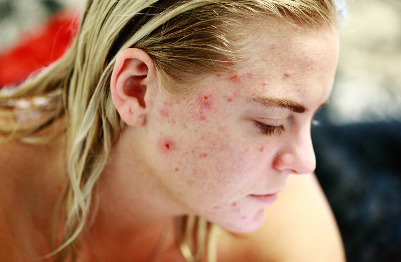  Illustrative image of acne. (photo credit: PIXABAY)