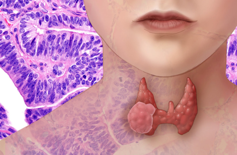  Thyroid cancer (Illustrative). (credit: NIH Image Gallery/Flickr)