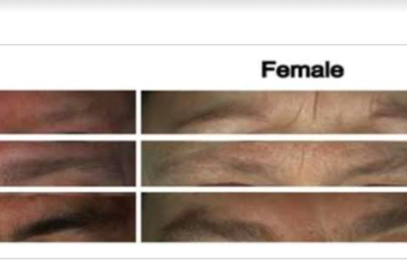  Example images illustrating eyebrow thickness classified into three categories, i.e. 0-thin, 1-intermediate,and 2-thick  (credit: Journal of Investigative Dermatology)