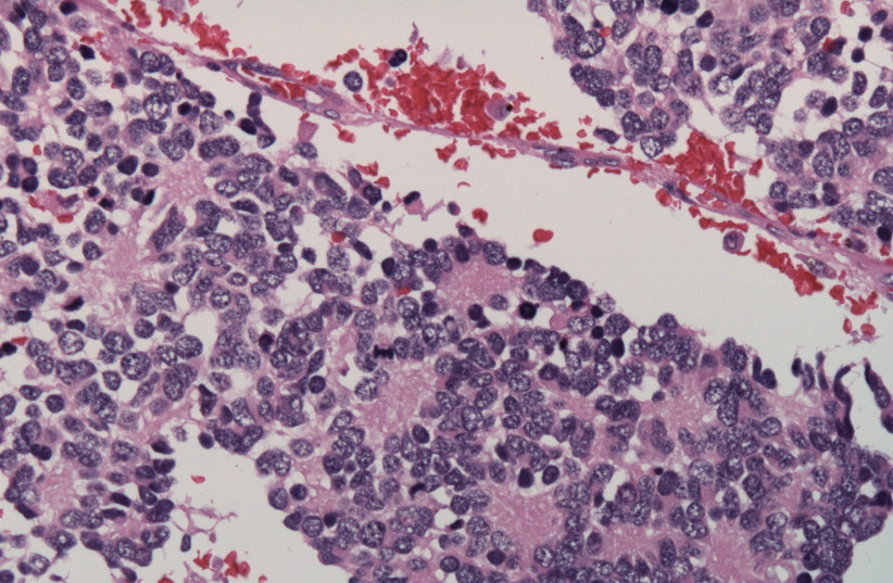  Illustrative image of neuroblastoma. (credit: Wikimedia Commons)