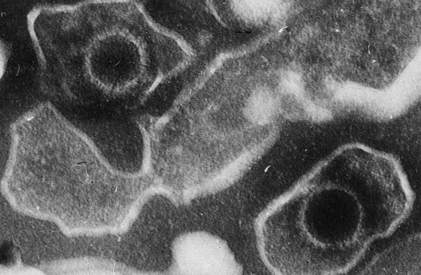 In this electron microscopic depiction, two Epstein Barr Virus virions, or viral particles, are captured, revealing spherical capsids containing genetic material, encased by a membrane envelope.