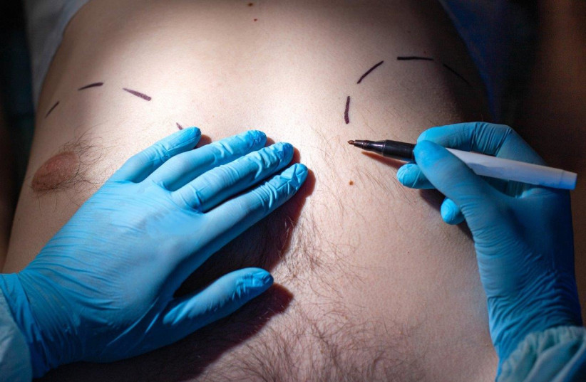  Cosmetic surgery procedure (illustrative). (credit: ISRAELI ASSOCIATION OF PLASTIC AND AESTHETIC SURGERY)