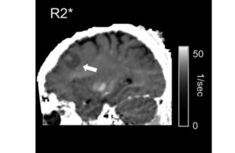  MRI. (credit: Dr. Tal Shahar, Prof. Aviv Mezer, Shir Filo,)