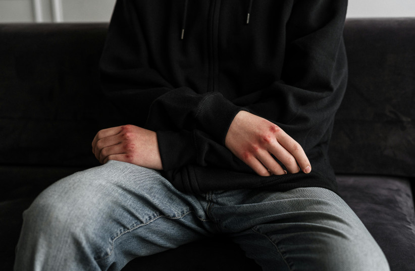  Teenager in black hoodie and jeans with bruised knuckles. (credit: PEXELS)