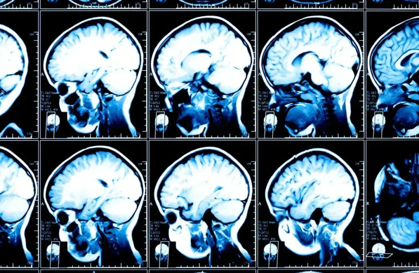 Brain scans (credit: SHUTTERSTOCK)