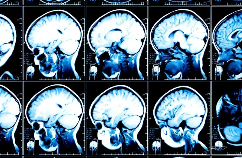  Escaneos cerebrales (credit: SHUTTERSTOCK)
