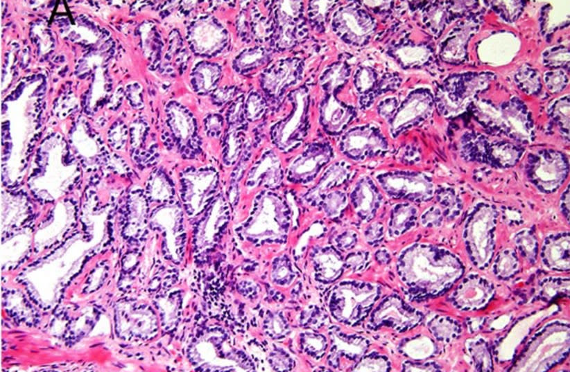 Micrografía de cáncer de próstata con puntuación de Gleason 6 (3+3)
