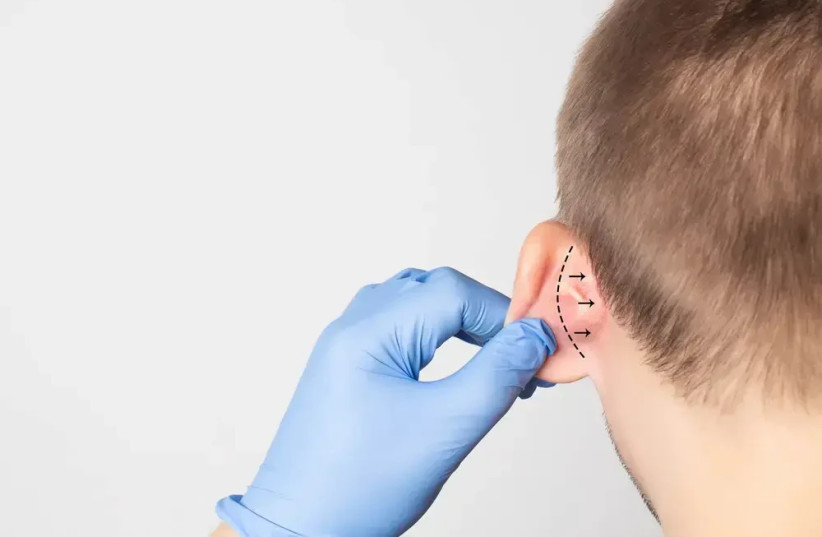  Surgery to correct protruding ears (credit: SHUTTERSTOCK)