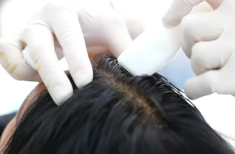  Injection of synthetic hair in the scalp (credit: Hairstatics)