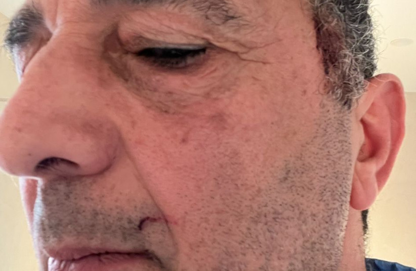  Amnon Ohana, 64, had his jaw broken by activists at a train station in Belgium for removing an anti-Israel sticker, May 17, 2024. (credit: Shira Ohana)