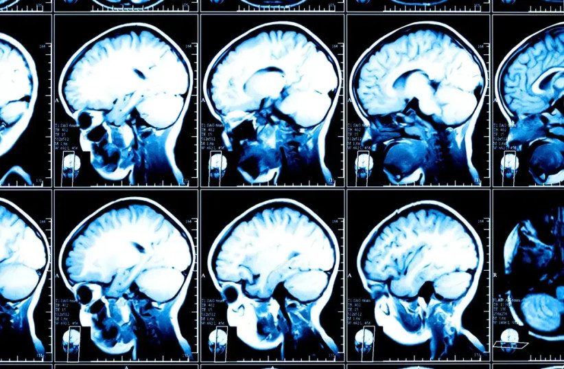 Among the super-agers, nearly twice as many immature nerve cells were found compared to their peers with normal memory, and two and a half times more than in Alzheimer’s patients