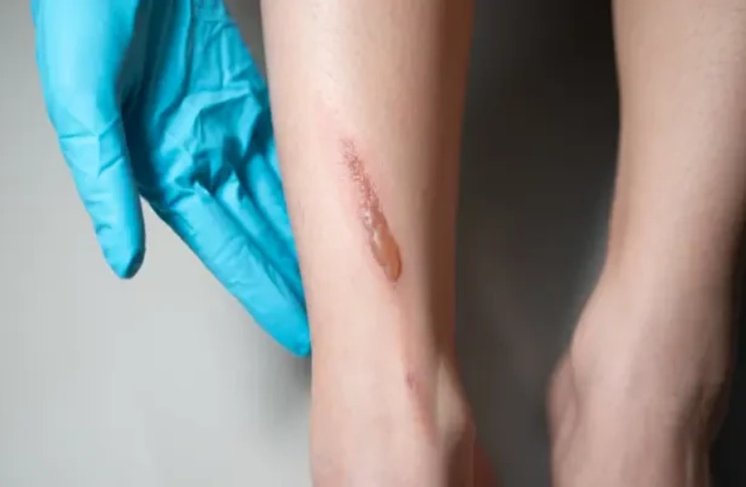 In case of a burn, the area should be cooled with lukewarm running water