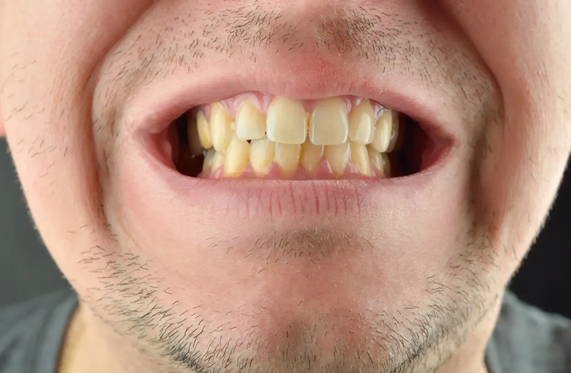 Chew sugar-free gum to increase saliva and avoid yellow teeth