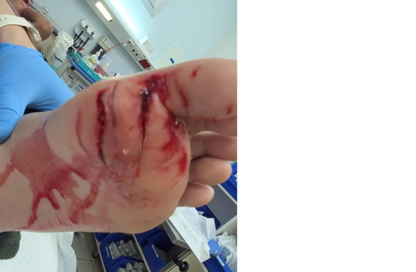 An examination at the hospital revealed that Shir was unable to move her big toe.