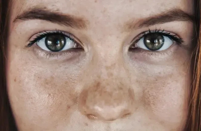Sunscreen is a central part of skin protection, but even using a product with a high protection factor does not guarantee complete prevention of pigmentation.