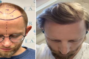 Turkey leads in affordable, high-quality FUE & DHI hair transplants with all-inclusive packages.