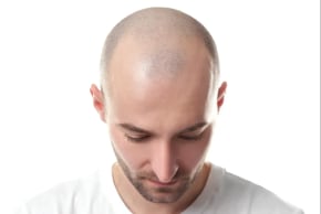 Finasteride, known by its commercial name Propecia, a common medication for treating hair loss and enlarged prostate, may also cause this phenomenon