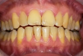Yellow teeth