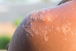 Despite the urge to remove the pieces of skin, Dr. Egozi warns against doing so